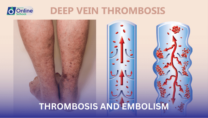 Lesson 14: Thrombosis and Embolism